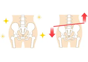 坐骨神経痛 骨盤